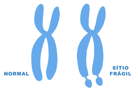 Cromossomo X frágil